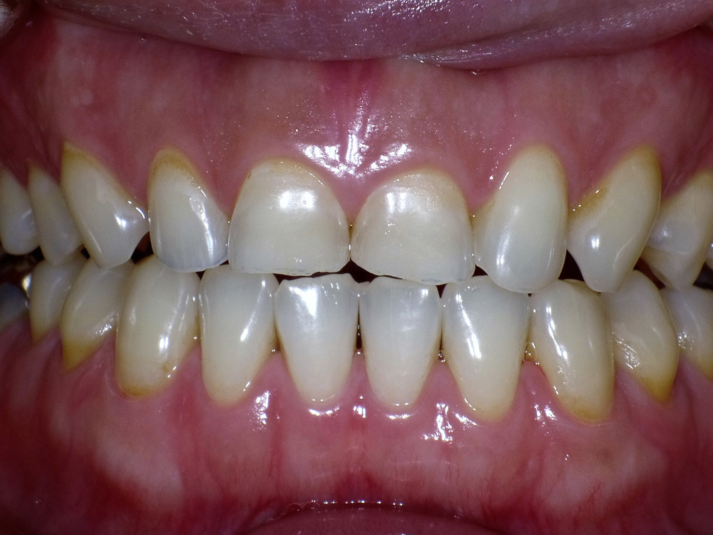 酸蝕歯について 酸蝕歯の治療なら 歯を削らずに治す西村歯科医院